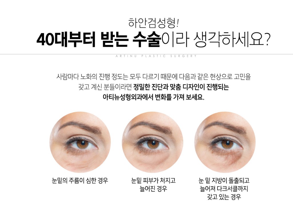 하안검 1단계