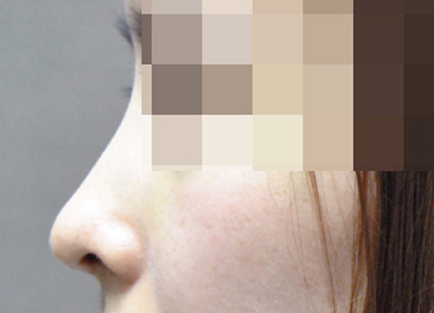 낮은 코성형 시술 후 — 측면