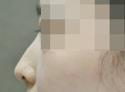 낮은 코성형 시술 전 — 측면