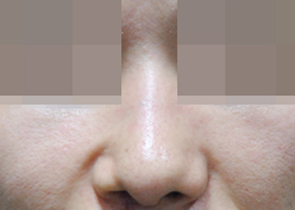 CASE 03 AFTER